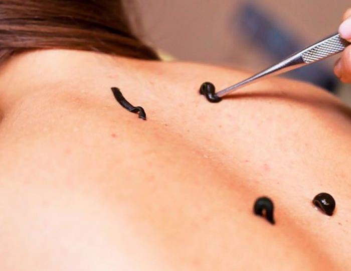 Гирудотерапия - Санаторий «Долина Нарзанов» РЖД-Здоровье Железноводск Гирудотерапия - Санаторий «Долина Нарзанов» РЖД-Здоровье Железноводск